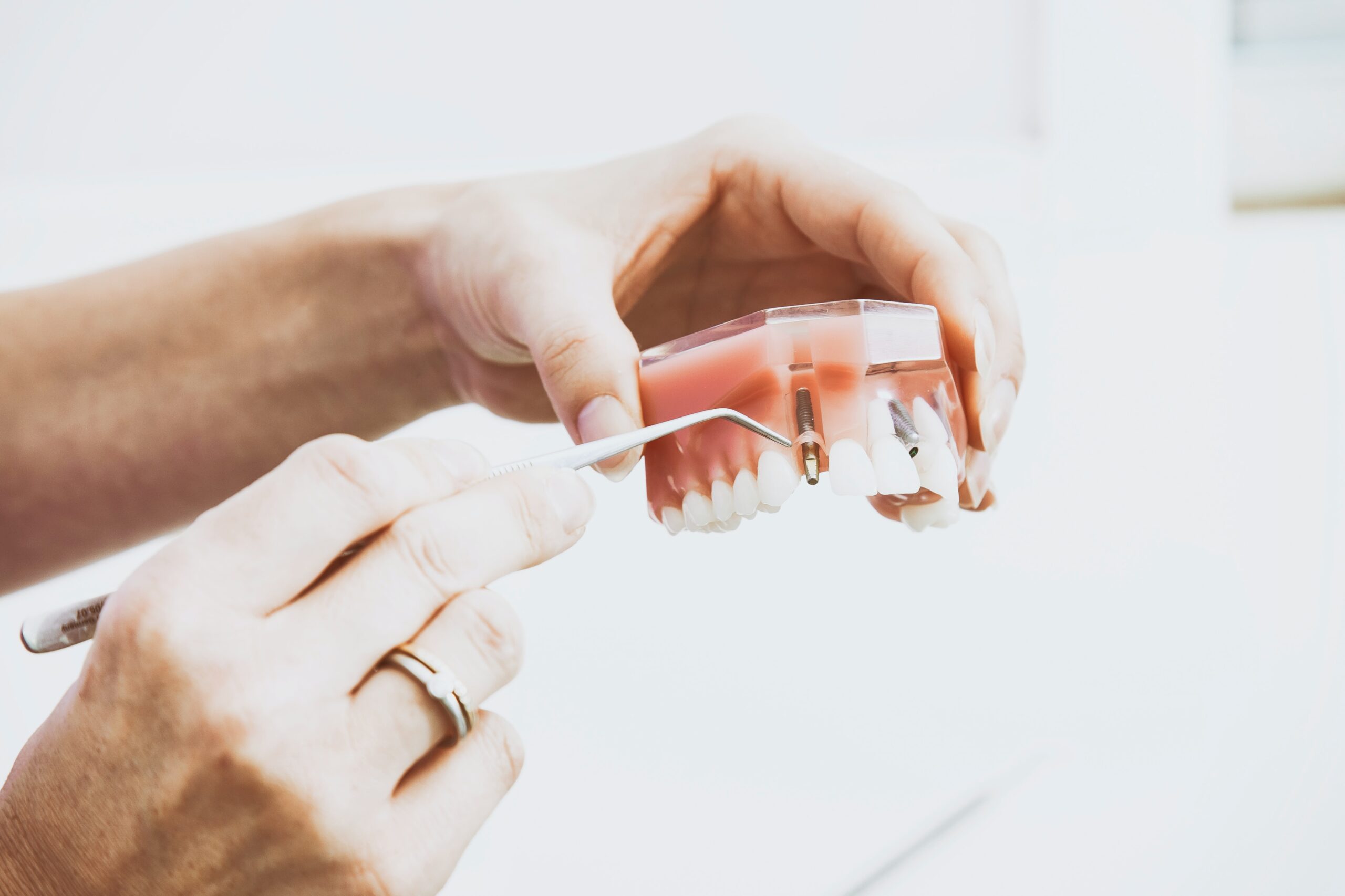 Denture Implants - LOTUS